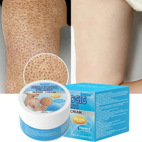 Repair Treatment Cream Exfoliating Removal Chicken Skin Cleaning Acne Spots Moisturizing Smooth Body Skin Care